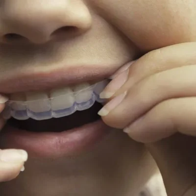 Фірма стоматологічних елайнерів Smile Direct Club закривається